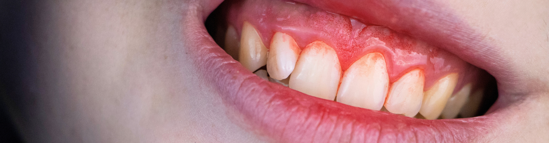 Gloved hand lifting person's upper lip to show bleeding gums.